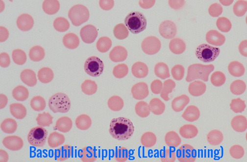 pappenheimer bodies vs basophilic stippling