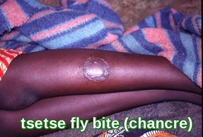 tsetse fly bite-chancre