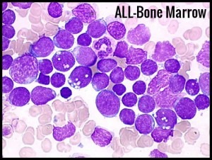 ALL-Bone Marrow