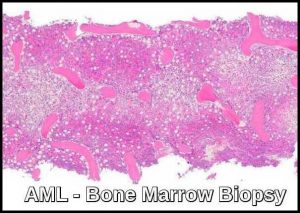 AML - Bone Marrow Biopsy