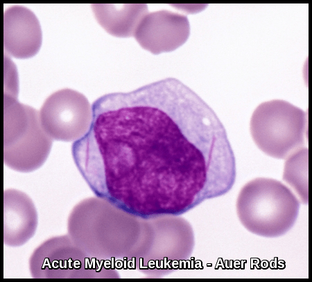 Acute Myeloid Leukemia - Auer Rods