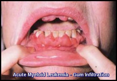 Acute Myeloid Leukemia - Gum Infiltration