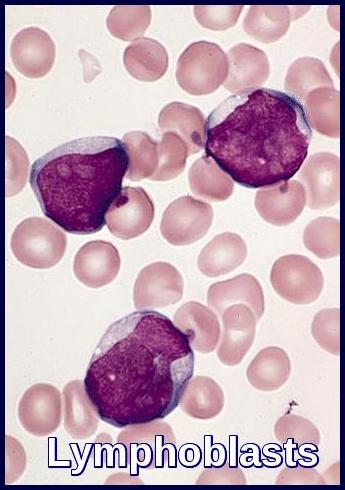 Peripheral blood smear showing lymphoblasts characteristic of Acute Lymphoblastic Leukemia (ALL).