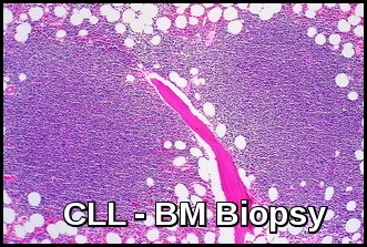 Chronic Lymphocytic Leukemia - BM Biopsy