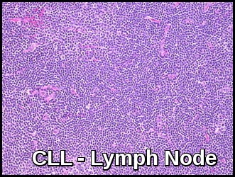 Chronic Lymphocytic Leukemia - Lymph Node