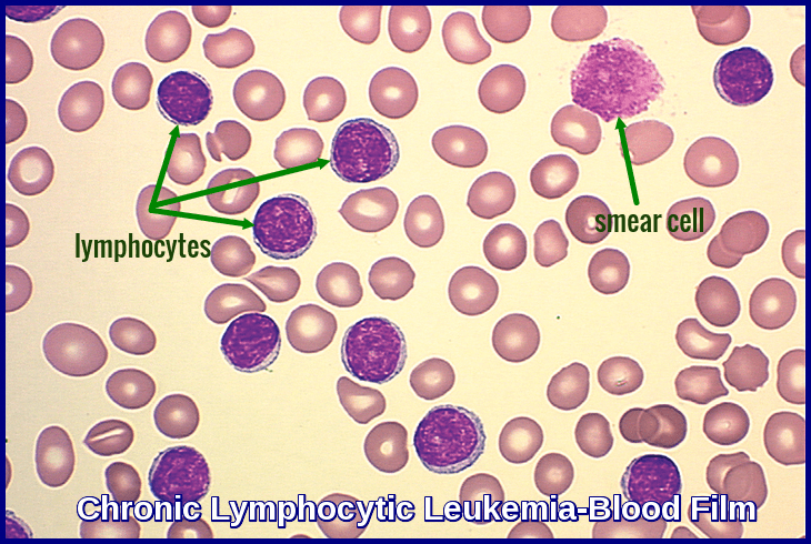 leukemia blood