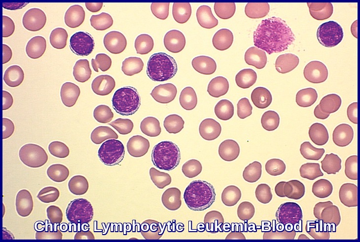 chronic lymphocytic leukemia symptoms