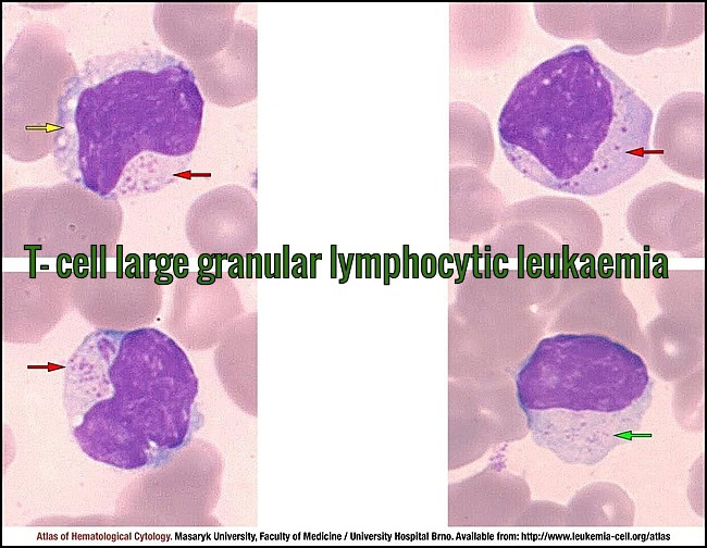 Cytology images showing T-cell large granular lymphocytes with characteristic azurophilic granules in T-cell large granular lymphocytic leukemia.