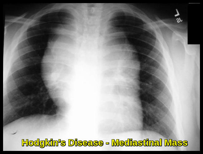 Hodgkin’s Disease - Mediastinal Mass