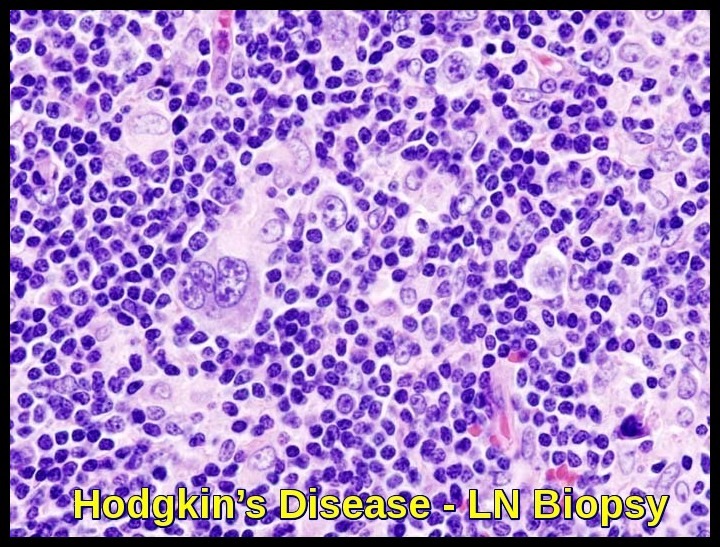 Hodgkin's Disease Mixed-Cellularity Type