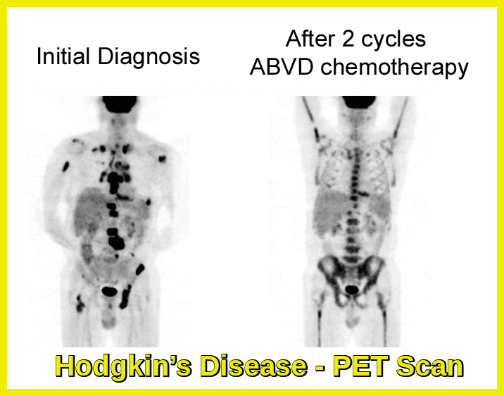 Hodgkin's Disease - PET Scan Before & After Treatment