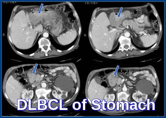 Non-Hodgkin Lymphoma