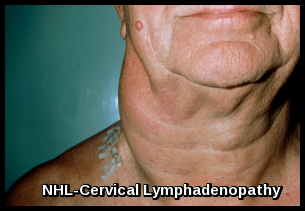 Non-Hodgkin Lymphoma