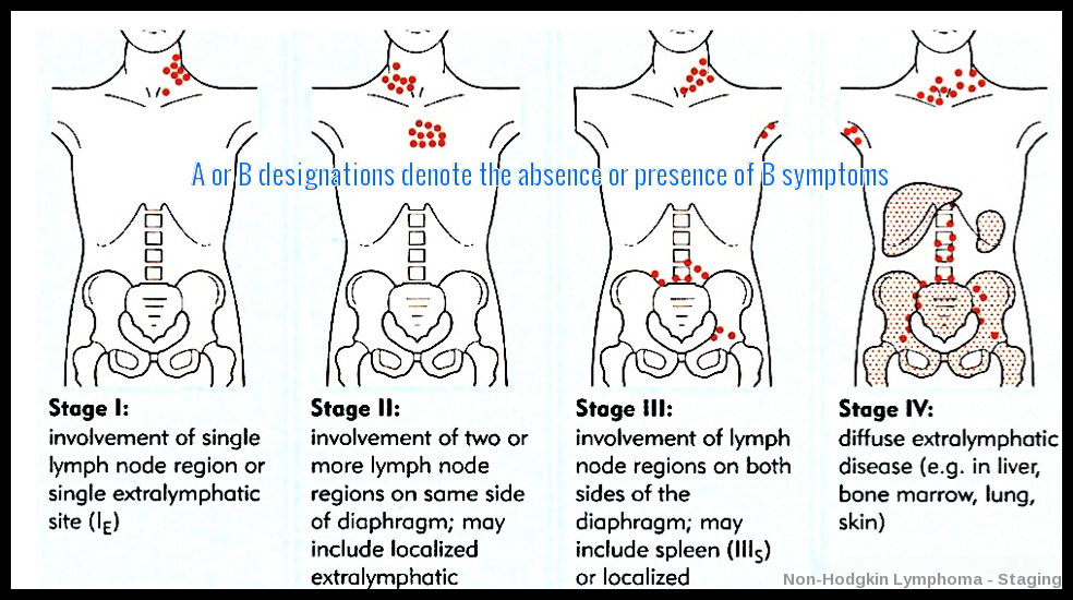 Non-Hodgkin Lymphoma | Ask Hematologist | Understand ...