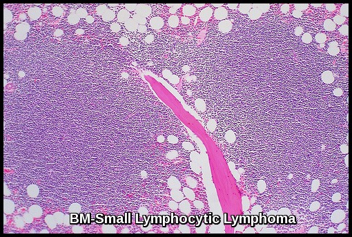 small-lymphocytic-lymphoma-in-marrow