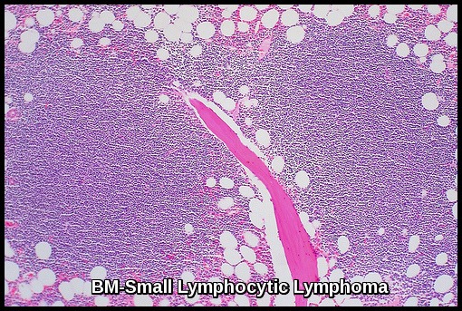 Non Hodgkin Lymphoma Ask Hematologist Understand Hematology 