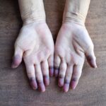 Acrocyanosis of hands in cold agglutinin disease showing bluish discoloration of fingers due to cold-induced red blood cell agglutination