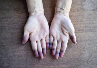 Acrocyanosis of hands in cold agglutinin disease showing bluish discoloration of fingers due to cold-induced red blood cell agglutination