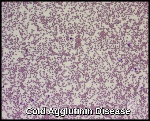 Cold Agglutinin Disease