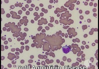 Cold Agglutinin Disease