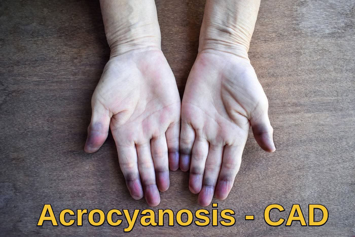 Acrocyanosis of hands in cold agglutinin disease showing bluish discoloration of fingers due to cold-induced red blood cell agglutination