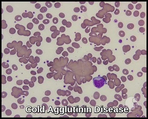 Cold Agglutinin Disease