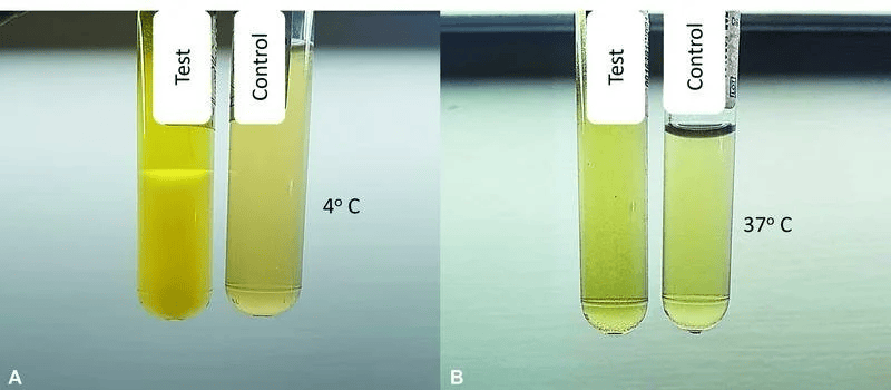 Qualitative test for cryoglobulin showing cryoglobulin deposits in patient serum at 4°C with disappearance after warming at 37°C