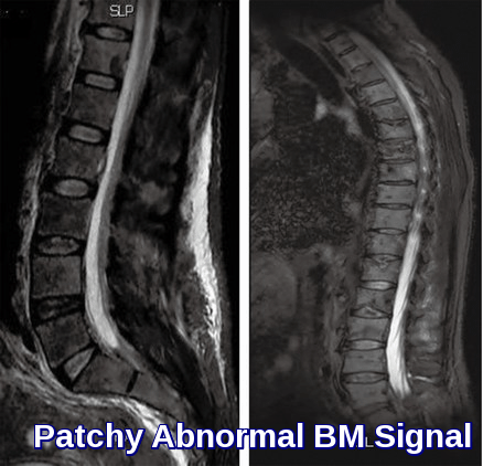 mri scan-abnormal bone marrow signal