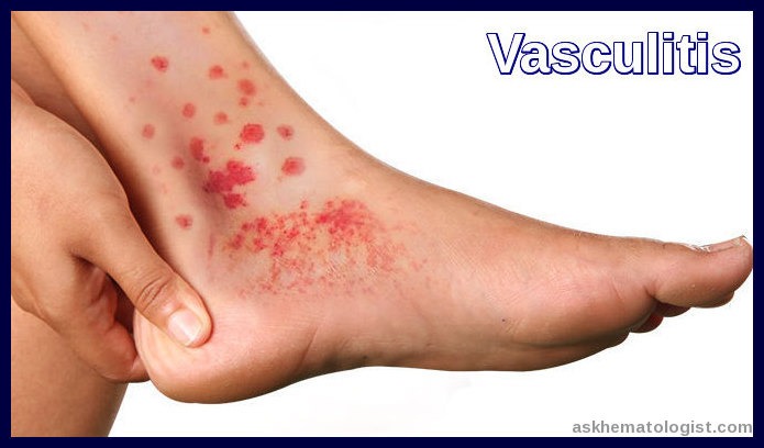 Vasculitis