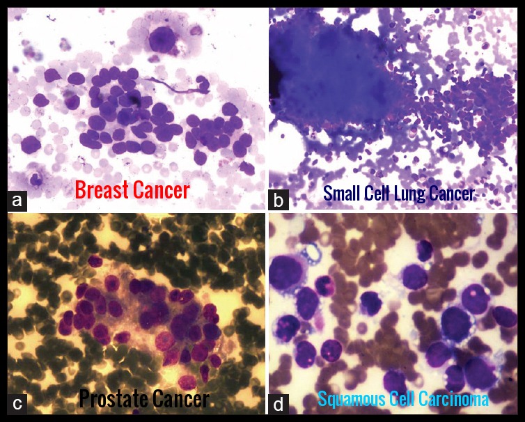 malignant-infiltration-of-bone-marrow.jp