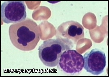 Myelodysplastic Syndrome