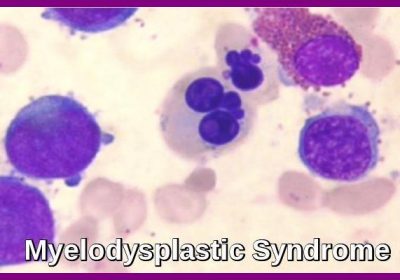 Myelodysplastic Syndrome