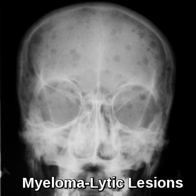 multiple myeloma x ray