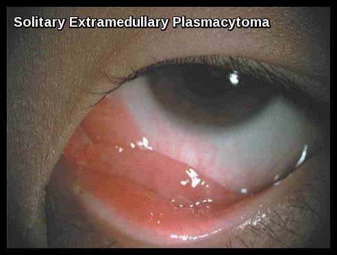 Multiple Myeloma