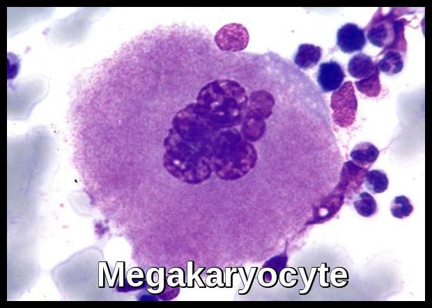 idiopathic thrombocytopenic purpura smear