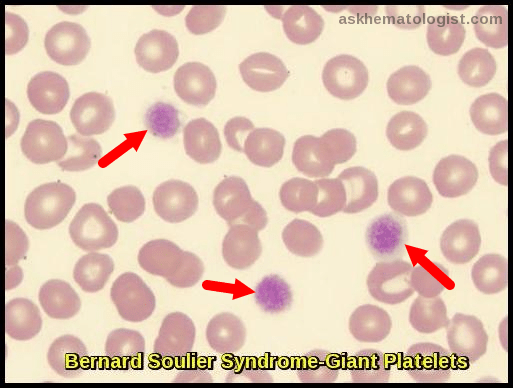 Qualitative platelet disorders