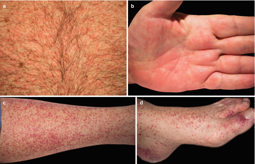 Stem Cell Transplantation