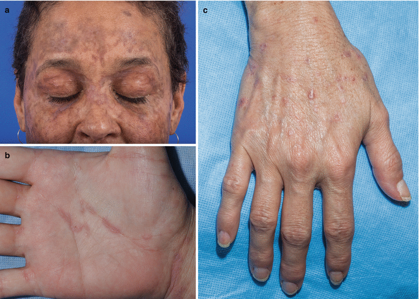 Stem Cell Transplantation