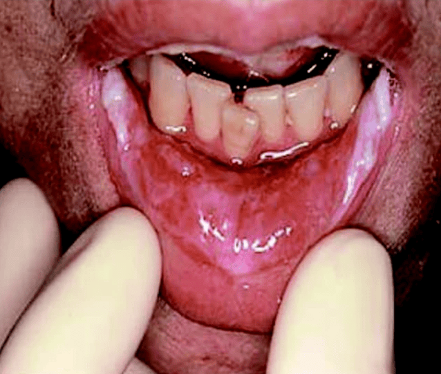 Stem Cell Transplantation