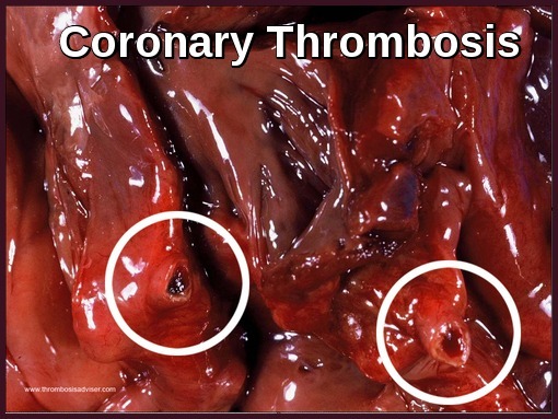 Gross pathological specimen showing coronary artery thrombosis with intraluminal clot
