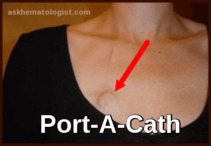 Port-A-Cath implanted under the skin for chemotherapy and long-term intravenous access