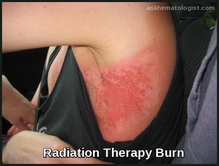 Radiation therapy burn showing erythematous skin reaction after radiotherapy treatment