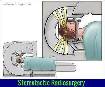 Stereotactic radiosurgery diagram showing focused radiation beams targeting brain tumor