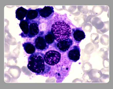 Bone marrow aspirate smear showing hemophagocytosis: a histiocyte (macrophage) actively ingesting red cell precursors (erythrophagocytosis)