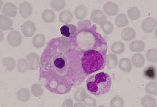Bone marrow showing erythrophagocytosis: a macrophage ingesting red blood cells and precursors. Indicative of HLH/MAS.