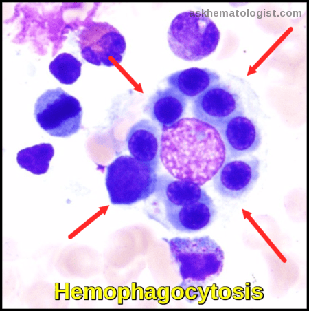 Hemophagocytosis