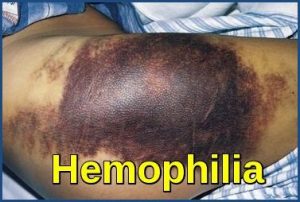 Hemophilia