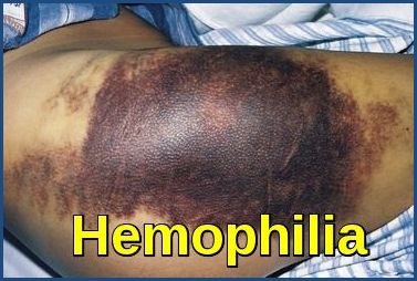 Hemophilia-Ecchymoses