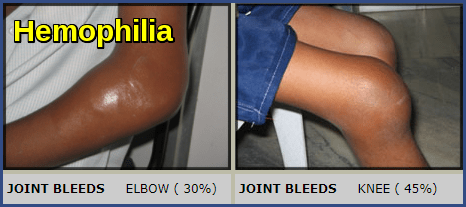 Hemophilia-Joint Bleeds