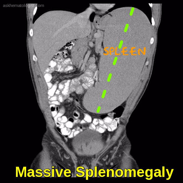 Spleen Disorders